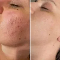 فشیال صورت درمان تیرگی و از بین بردن جوش