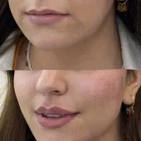 تخفیفات تزریق ژل و بوتاکس تخصصی درکلینیک توسط پزشک|خدمات زیبایی و سلامت|کرج, گوهردشت|دیوار