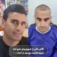 کلینیک تخصصی کاشت مو و ابرو لیان