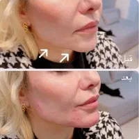 خدمات زیبایی تزریق بوتاکس و فیلر prp مزوژل|استخدام درمانی، زیبایی، بهداشتی|کرمانشاه, |دیوار