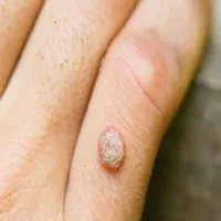 برداشت زیگیل و خالبرداری و میخچه و واکسن|خدمات زیبایی و سلامت|تبریز, |دیوار
