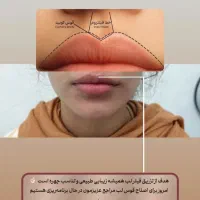 آخرین تخفیف ژل و فیلر، بوتاکس، مزوتراپی، پی آرپی|خدمات آرایشگری و زیبایی|آق قلا, |دیوار