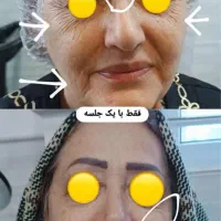 فیشالدرمطب/درمانجوشوخشکی/هایفو