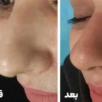 پلاسما کل صورت برداشتن خال تخفیف محرم