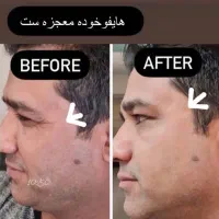 هایفو جوانسازصورت رفع غبغب تضمینی