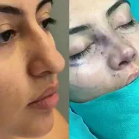 جشنواره عمل بینی با تخفیف آبان به رسم هرساله|خدمات آرایشگری و زیبایی|ساری, |دیوار