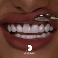 کامپوزیت/لمینت/دندانپزشکی