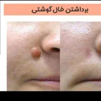 برداشتن خال های گوشتی و انجام تتو بدن و فیبروز|خدمات آرایشگری و زیبایی|ارومیه, |دیوار