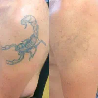 لیزر لک کک و مک و رفع تتو ولیزرموهای زاید|خدمات آرایشگری و زیبایی|نسیمشهر, |دیوار