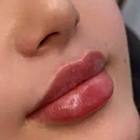 آموزش تزریق بوتاکس و ژل و مزوتراپی توسط پزشک