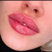 ژل لب گونه چانه بوتاکس جوانساز