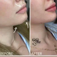 خدمات زیبایی ساکشن و تزریق فیلر های بادی|خدمات آرایشگری و زیبایی|خرمآباد, |دیوار