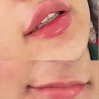 تزریق ژل (فیلر) و بوتاکس|خدمات آرایشگری و زیبایی|شیراز, عادل آباد|دیوار