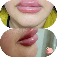 تزریق ژل و بوتاکس|خدمات آرایشگری و زیبایی|لامرد, |دیوار