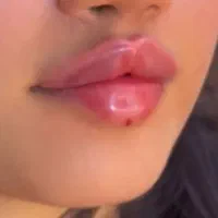 تزریق ژل وبوتاکس با مدرک 950