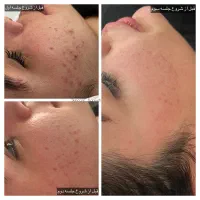 فیشال و پاکسازی پوست