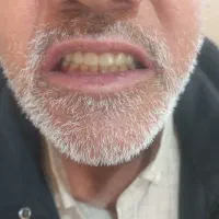 ساخت عنواع دندان مصنوعی ایرانی وخارجی|خدمات آرایشگری و زیبایی|آشخانه, |دیوار