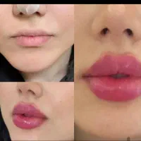 تزریق ژل و بوتاکس .کانتوریگ صورت .زاویه سازی|خدمات آرایشگری و زیبایی|بروجن, |دیوار