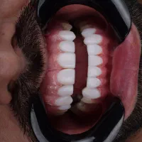 عصب کشی و ترمیم|خدمات آرایشگری و زیبایی|مشهد, آزادشهر|دیوار