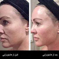 هایفوتراپی صورت و غبغب و شکم|خدمات آرایشگری و زیبایی|تبریز, |دیوار
