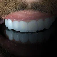 جراحی ایمپلنت( نمایندگی دنتیس )|خدمات آرایشگری و زیبایی|تهران, میدان ولیعصر|دیوار