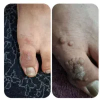 دیگه نگران از بین رفتن زگیل و خال نباش