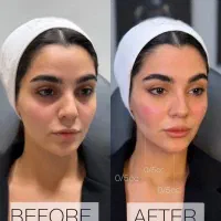 ژل بوتاکس فقط450
