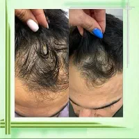 متد علمی رویش مجدد ریش و موی سر|آرایشی، بهداشتی، درمانی|تهران, اختیاریه|دیوار