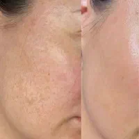 پی ار پی prp صورت/مو/رفع مشکلات پوست|خدمات زیبایی و سلامت|کرمانشاه, |دیوار