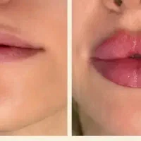 آف تزریق ژل لب