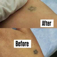 رفع تیرگی بدن  و لیزر تتوهای قدیمی بدن و صورت|خدمات آرایشگری و زیبایی|یاسوج, |دیوار