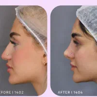 آف مکس لیفت صورت بینی شقیقه لب ابرو غبغب ژل زاویه|خدمات زیبایی و سلامت|مشهد, هنرستان|دیوار