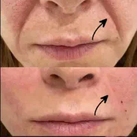 لیپوساکشن چربی جراحی بلفارو لیفت نخ ژل