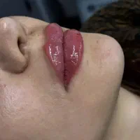 خدمات تخصصی ژل و بوتاکس و مزو