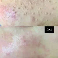 (تخفیف)پاکسازی پوست
