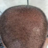 تخفیف ویژه کاشت مو