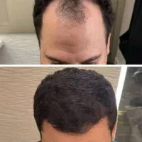 از دم قسط کاشت مو و ابرو بلفاروغبغب کلینیک حس زیبا|خدمات آرایشگری و زیبایی|اصفهان, سعادت‌آباد|دیوار