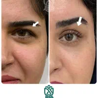 جراحی پلک بالا با بخیه لیزری
