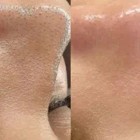 تخفیف یلدایی پاکسازی پوست فقط ۵۰۰تومن|خدمات آرایشگری و زیبایی|محمدیه-قزوین, |دیوار