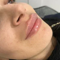 فیلروبوتاکس