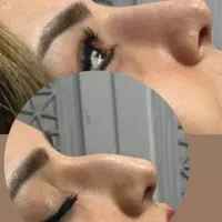 هایفو بوتاکس ژل لب زاویه سازی فیلر بادی هیپ سینه|خدمات آرایشگری و زیبایی|تهران, نارمک|دیوار