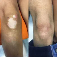 درمان تضمینی پیسی و پسوریازیس|خدمات آرایشگری و زیبایی|مشگین شهر, |دیوار