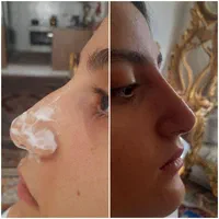 ژل بوتاکس مزو فیلر انزیم فیلر فشیال|خدمات آرایشگری و زیبایی|اسلامشهر, مطهری|دیوار