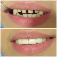 تخفیفات دندانپزشکی (بزرگسال و اطفال)