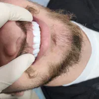 زیبایی،کامپوزیت دندان،عصب کشی(یاسوج)