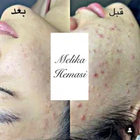 فیشیال و جوانسازی و پاکسازی صورت|خدمات آرایشگری و زیبایی|اصفهان, خلجا|دیوار