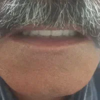 ساخت عنواع دندان مصنوعی ایرانی وخارجی|خدمات آرایشگری و زیبایی|آشخانه, |دیوار