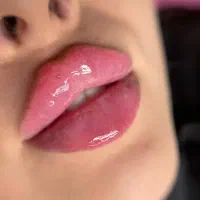 ژل / فیلر / بوتاکس در کلینیک زیبایی