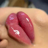 فیلر لب ژل گونه فک بوتاکس لیزرساکشن غبغب کاشت مو