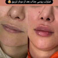 بوتاکس ژل آنزیم نخ لاغری بوتاکس 500وژل اودری350|خدمات آرایشگری و زیبایی|قم, هفت تیر|دیوار